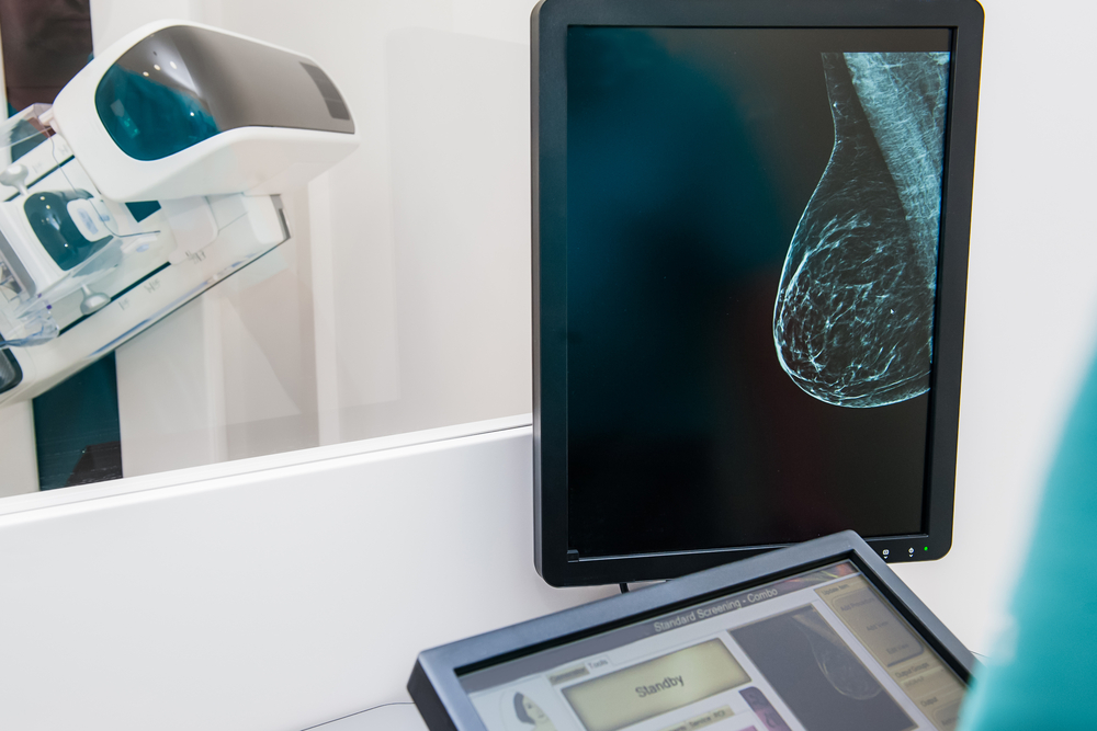 Você sabe o que é Mamografia digital?